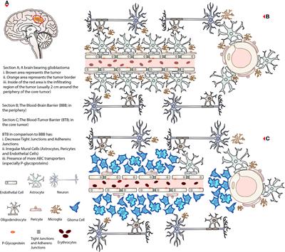 Low-Intensity Focused Ultrasound Technique in Glioblastoma Multiforme Treatment